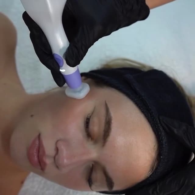 Jet Plasma for acne at Hans Esthetics in Plainfield, IL