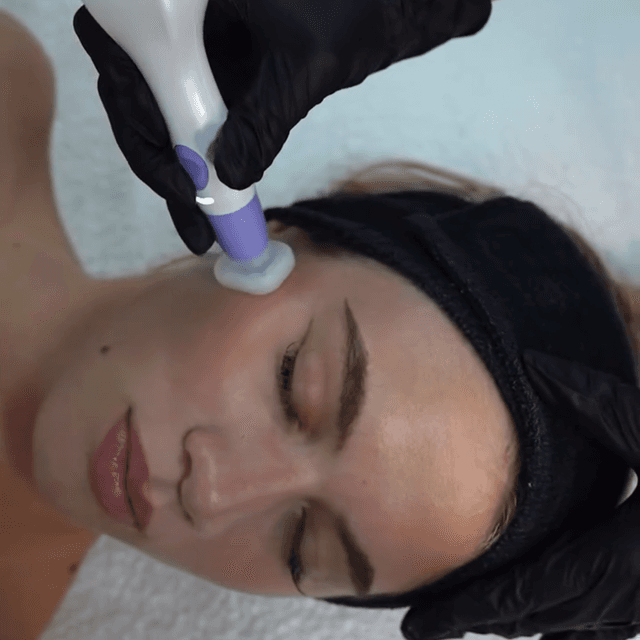 Jet Plasma for Hyperpigmentation at Hans Esthetics in Plainfield, IL