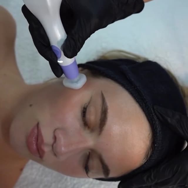 Jet Plasma for anti-aging at Hans Esthetics in Plainfield, IL